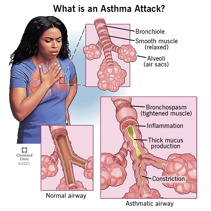 Bronchial Asthma Treatment