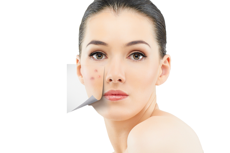 Acne Treatment Services