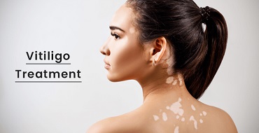 Vitiligo Treatment Services