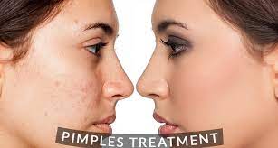 Pimples Treatment