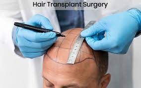 Hair Transplant Cosmetic Surgery