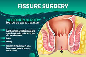 Fissures Treatment