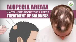 Alopecia Areata Treatment Services